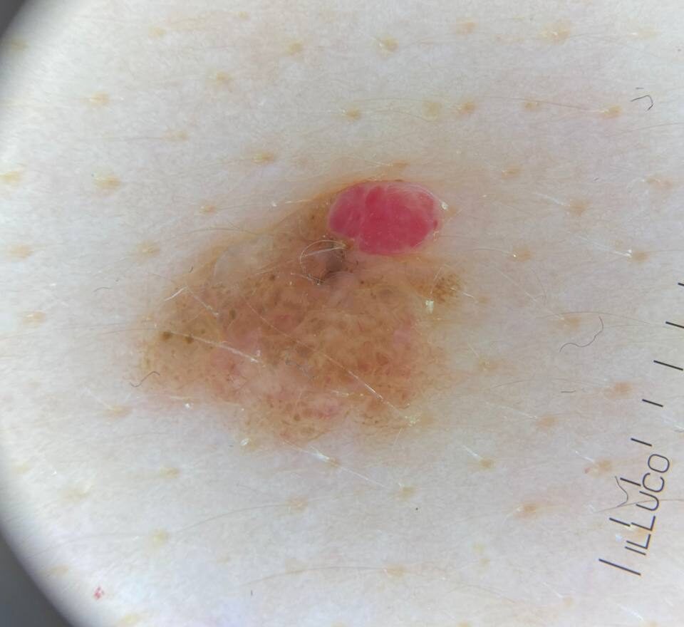 Дерматолог в Ирпене