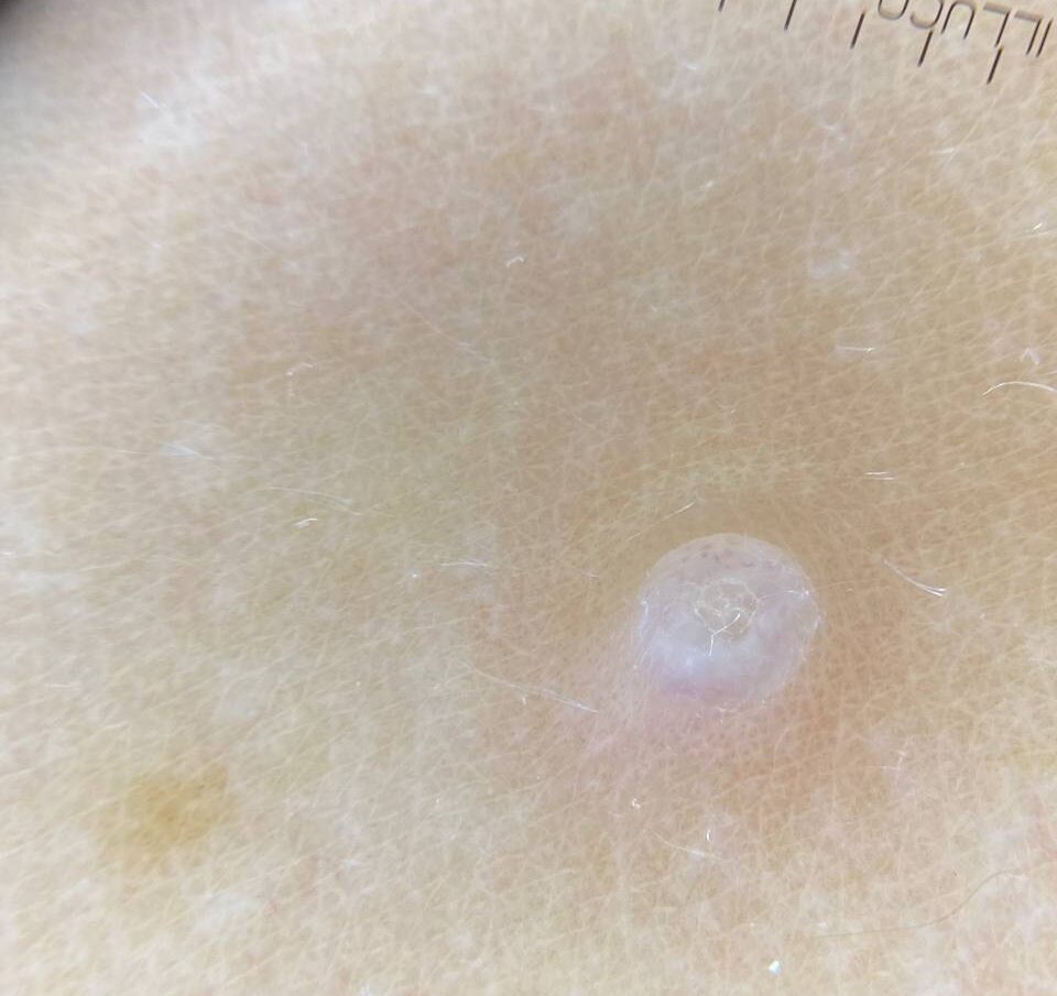 Дерматолог в Ирпене